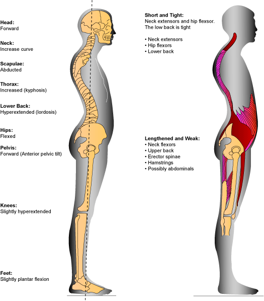 Kyphosis Exercises Perform exercises with the