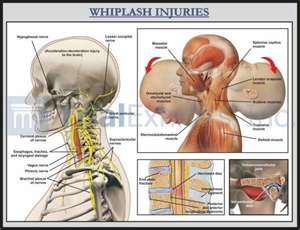 Whiplash Injuries