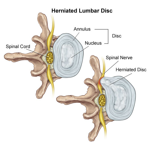 Herniated Disc